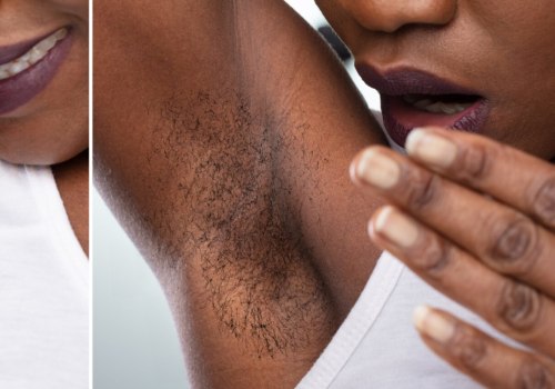 Why Laser Hair Removal is Safe and Effective for Dark Skin